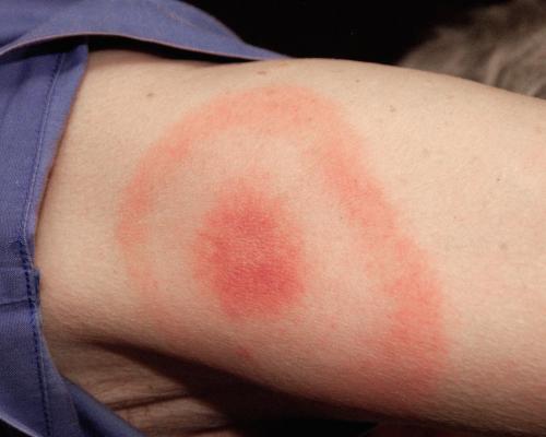 Flåtbid med rød plet