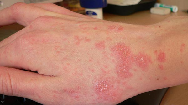 Fnat udslæt på hud