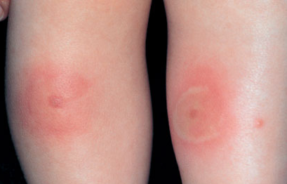 Generelt billede af insektbid på ben