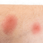 hvordan ser de forskellige insektbid ud