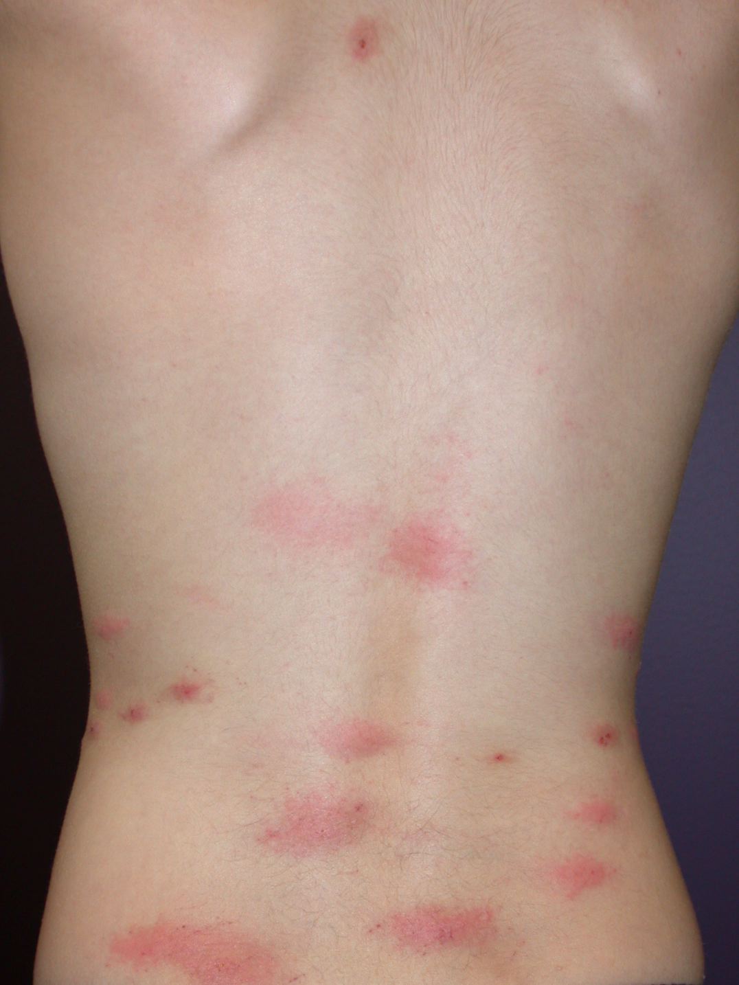 Loppebid på ryg – mange små røde prikker samlet