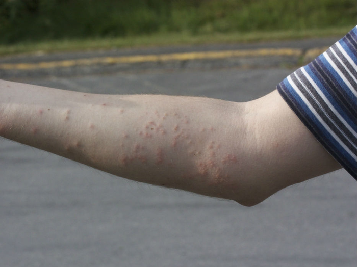 Væggelusbid på arm – røde hævelser i mønster